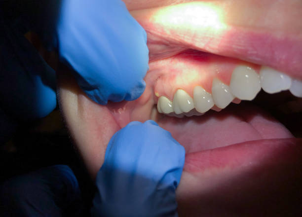 Best Emergency Dentist for Knocked-Out Tooth in Pinch, WV